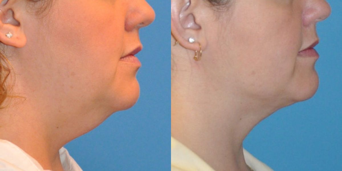 Neck Liposuction #2 - Before and After