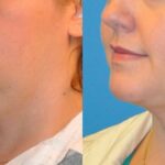 Neck Liposuction #2 - Before and After