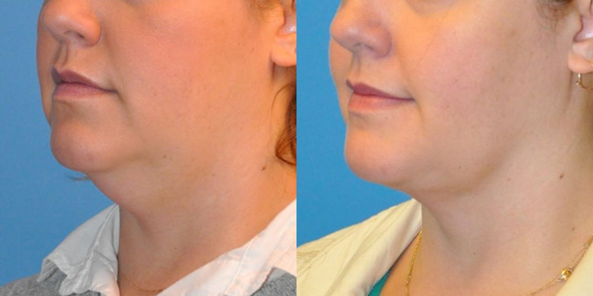 Neck Liposuction #2 - Before and After
