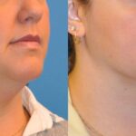 Neck Liposuction #2 - Before and After