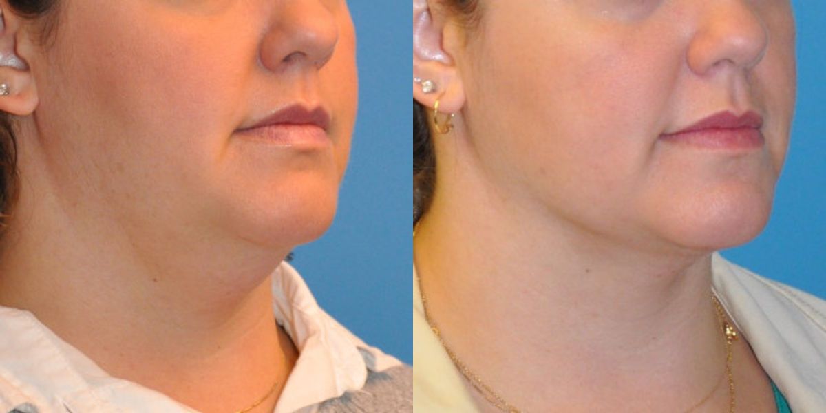 Neck Liposuction #2 - Before and After
