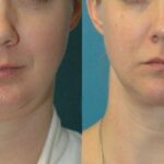 Neck Liposuction #3 - Before and After