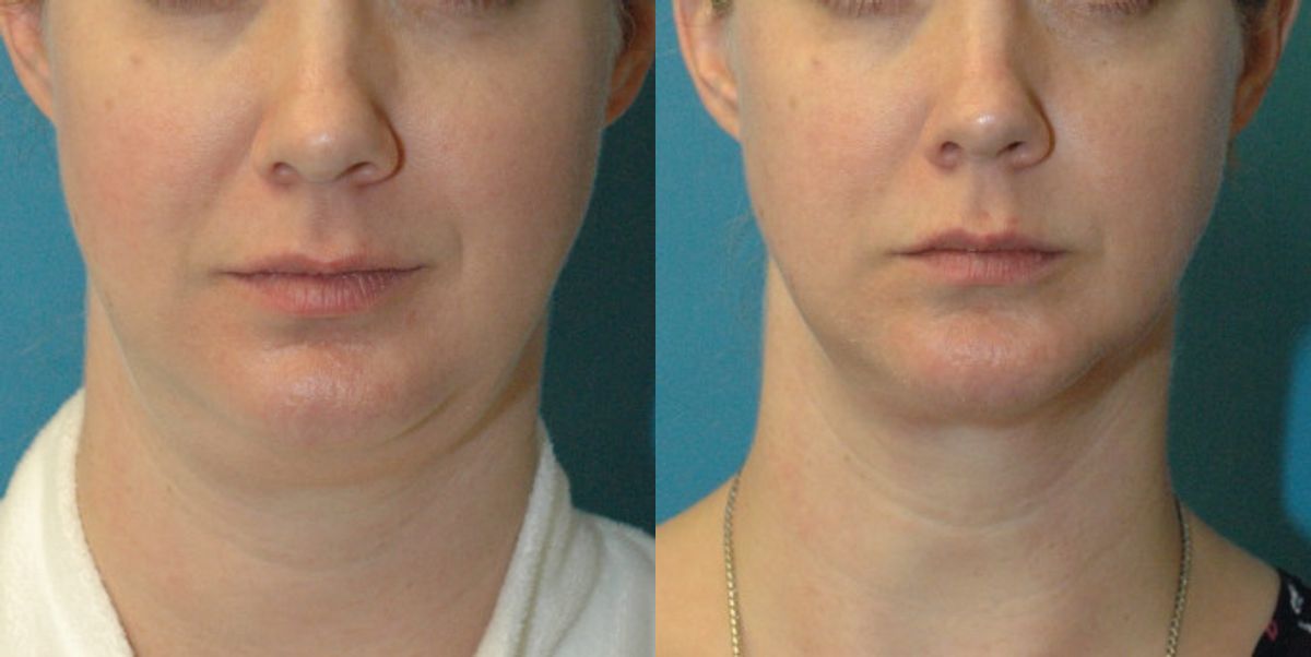 Neck Liposuction #3 - Before and After