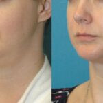 Neck Liposuction #3 - Before and After