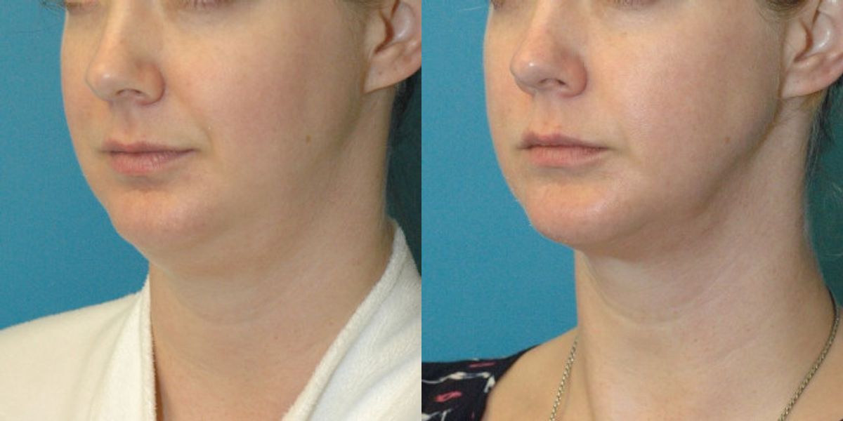 Neck Liposuction #3 - Before and After