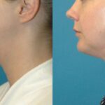 Neck Liposuction #3 - Before and After