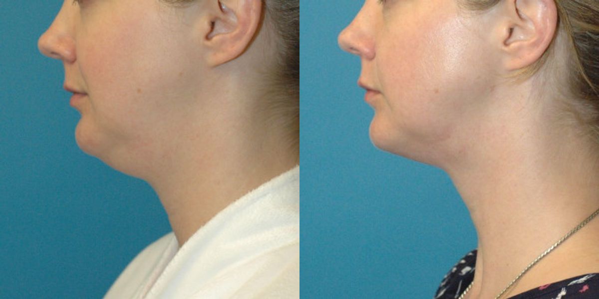 Neck Liposuction #3 - Before and After