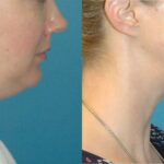 Neck Liposuction #3 - Before and After