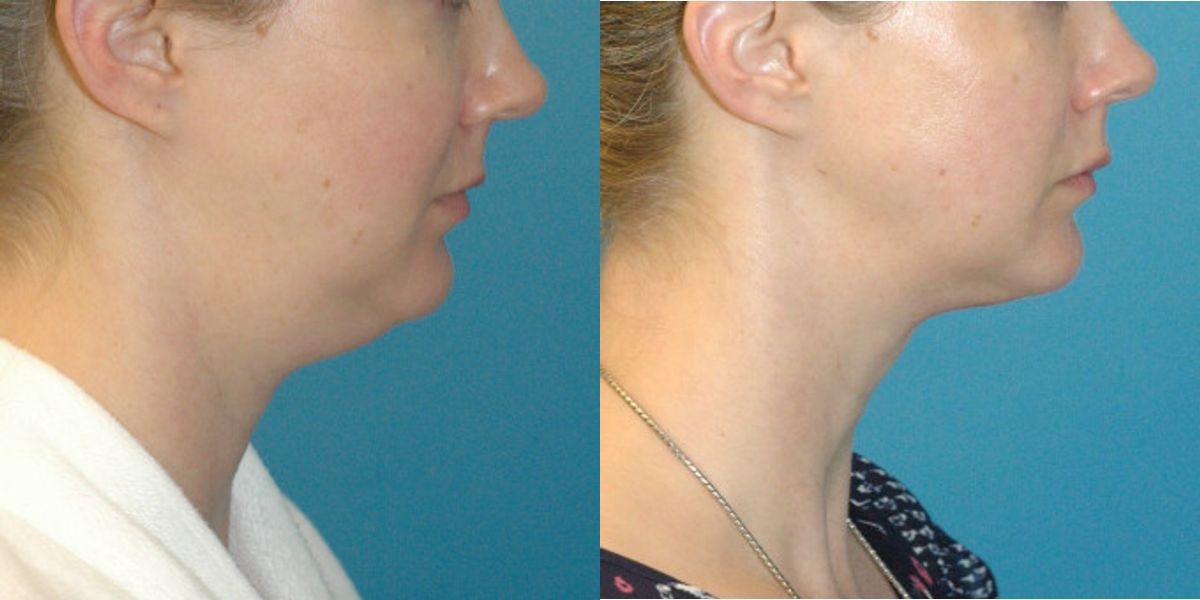Neck Liposuction #3 - Before and After