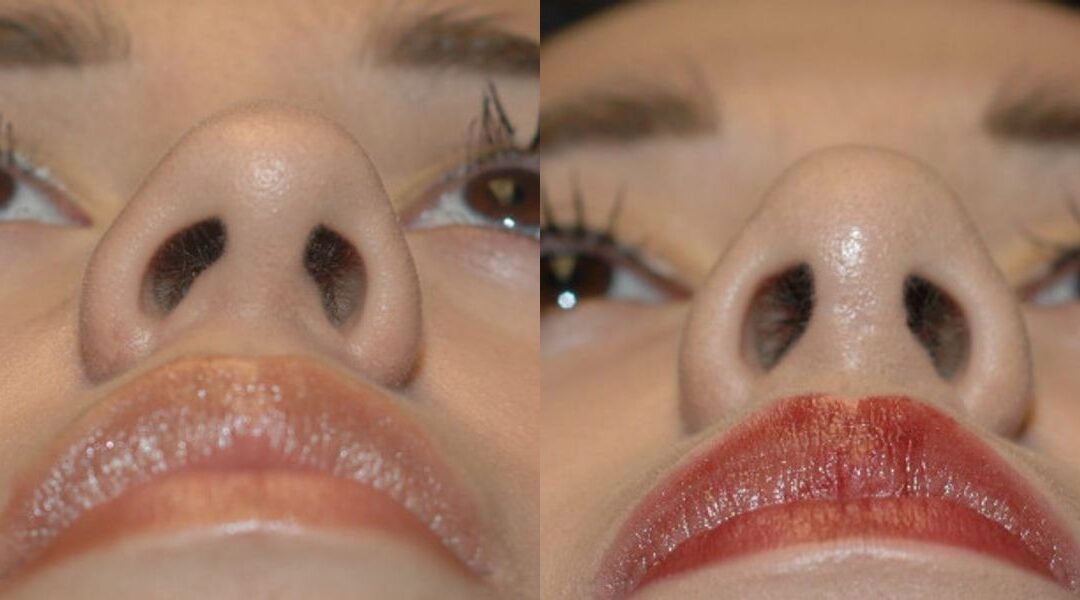 Rhinoplasty #1