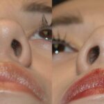 Rhinoplasty #1 - Before and After