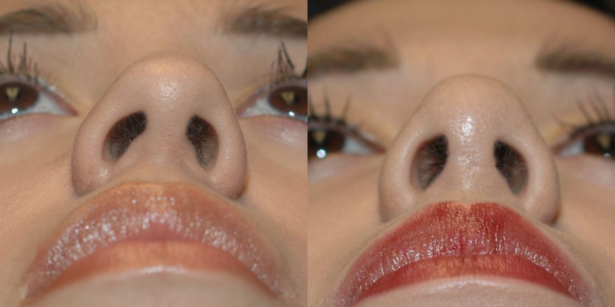 Rhinoplasty #1 - Before and After