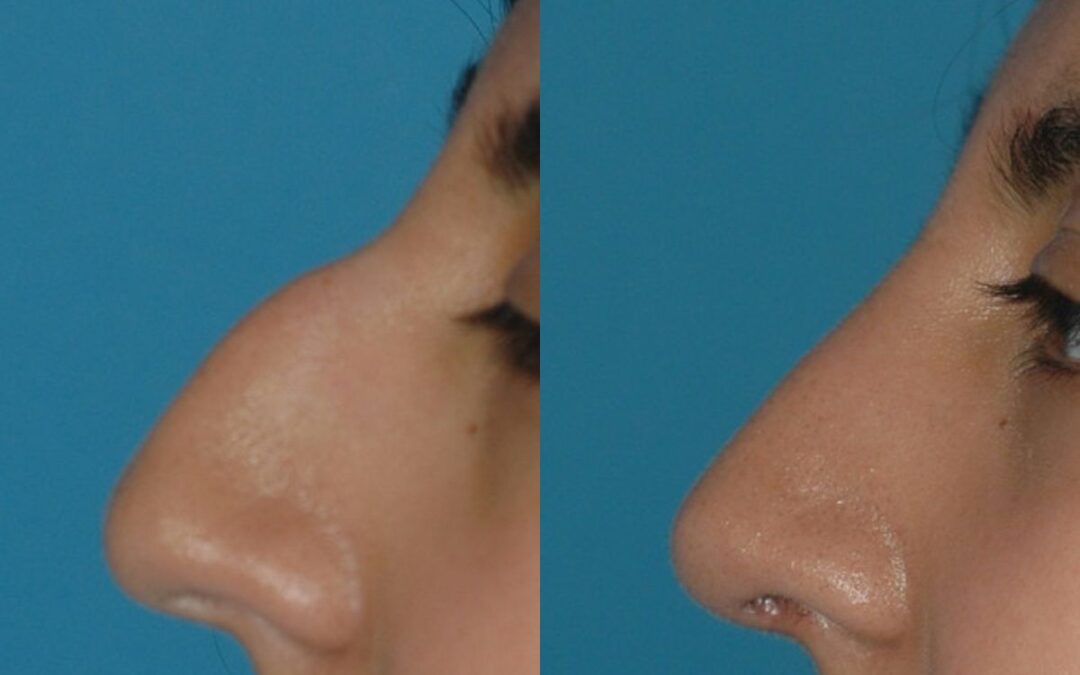 Rhinoplasty #2