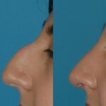 Rhinoplasty #2 - Before and After