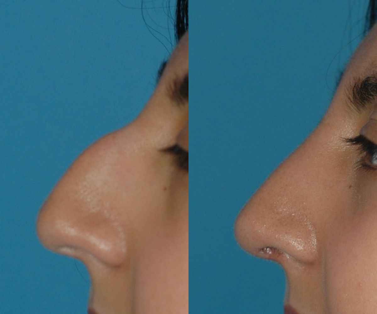 Rhinoplasty #2 - Before and After