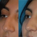Rhinoplasty #2 - Before and After