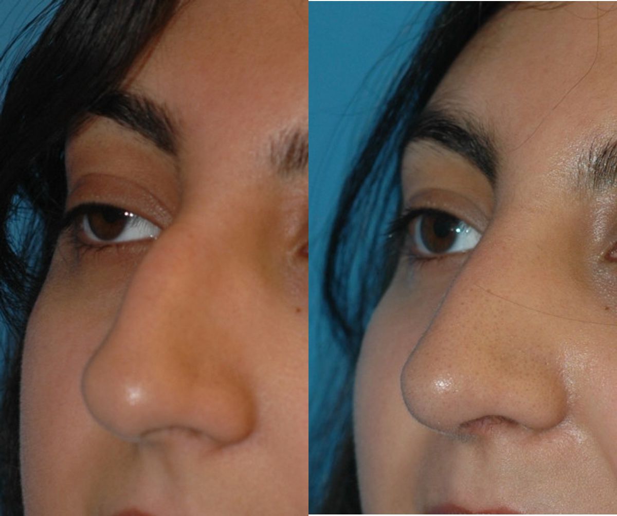 Rhinoplasty #2 - Before and After