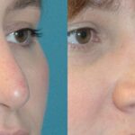 Rhinoplasty #3 - Before and After