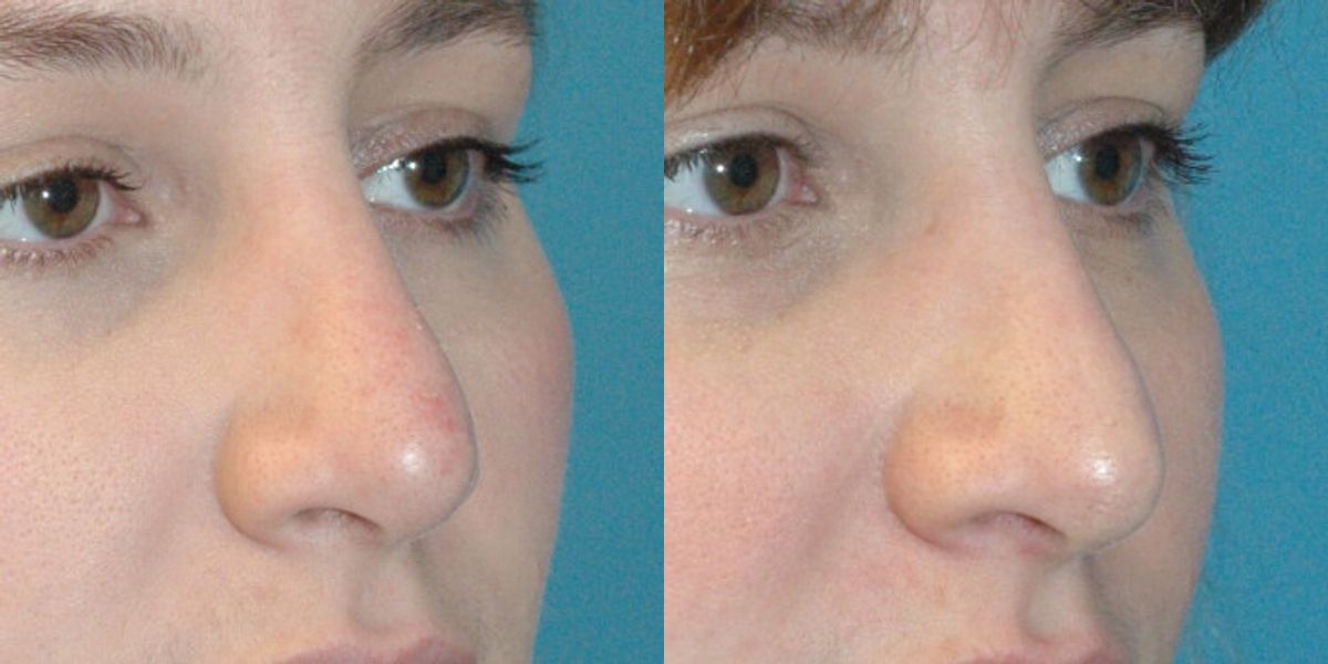 Rhinoplasty #3 - Before and After