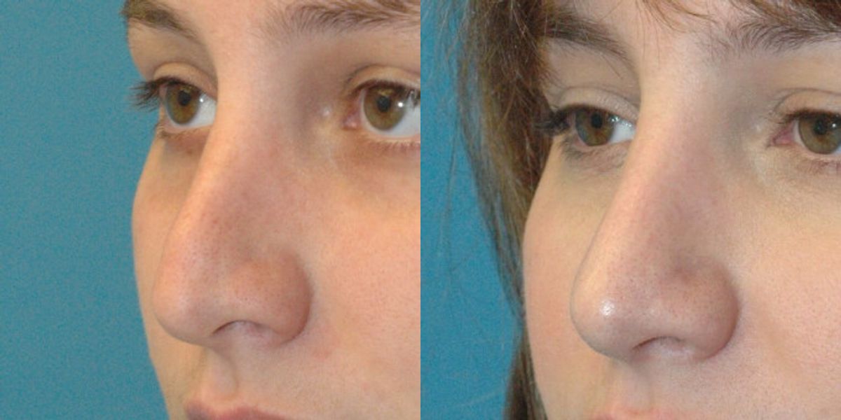 Rhinoplasty #3 - Before and After