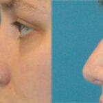 Rhinoplasty #3 - Before and After