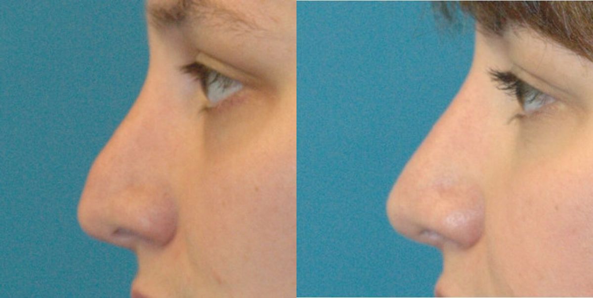 Rhinoplasty #3 - Before and After