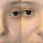 Rhinoplasty #4 - Before and After