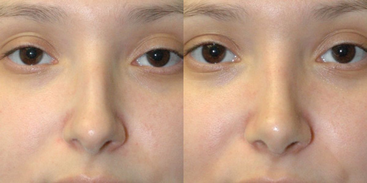 Rhinoplasty #4 - Before and After