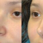 Rhinoplasty #4 - Before and After