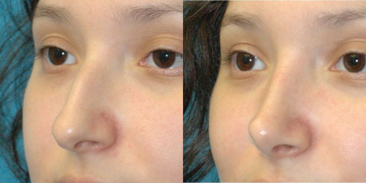 Rhinoplasty #4 - Before and After