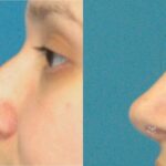 Rhinoplasty #4 - Before and After