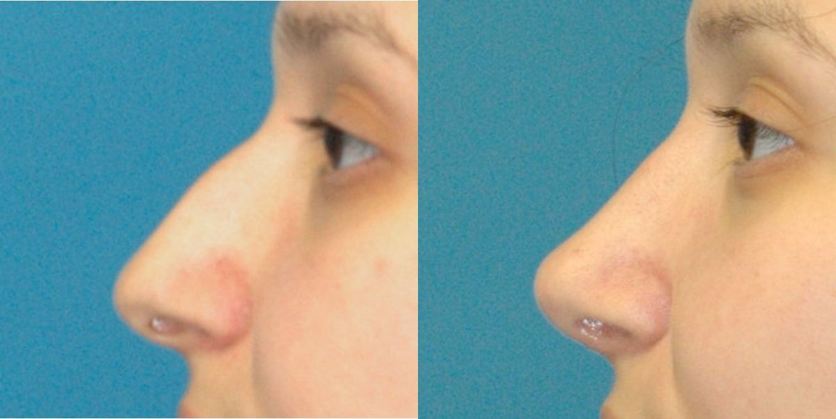 Rhinoplasty #4 - Before and After