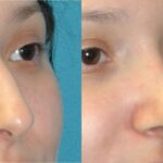 Rhinoplasty #4 - Before and After