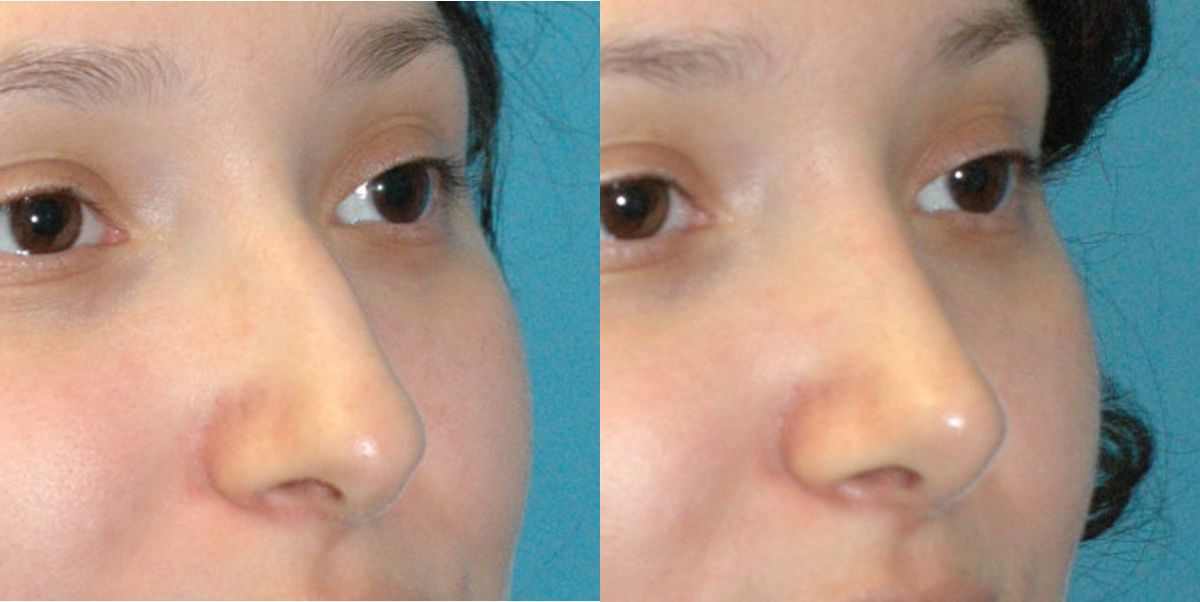 Rhinoplasty #4 - Before and After