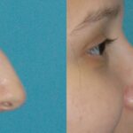 Rhinoplasty #4 - Before and After