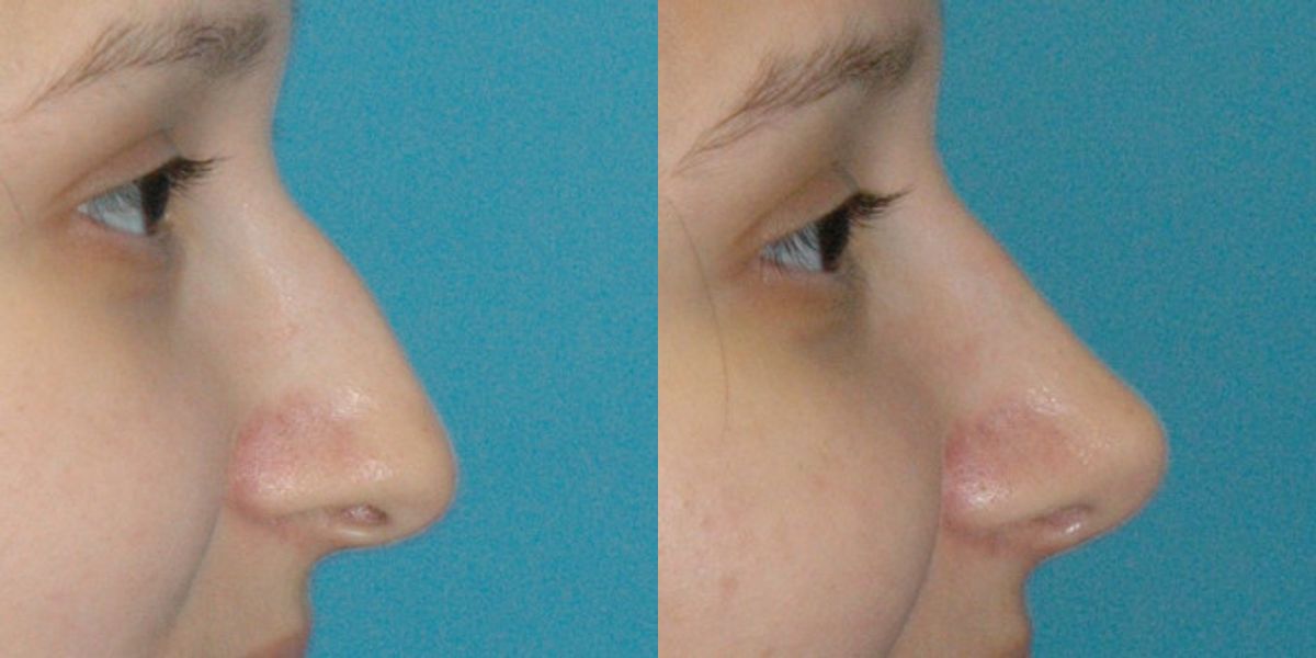 Rhinoplasty #4 - Before and After