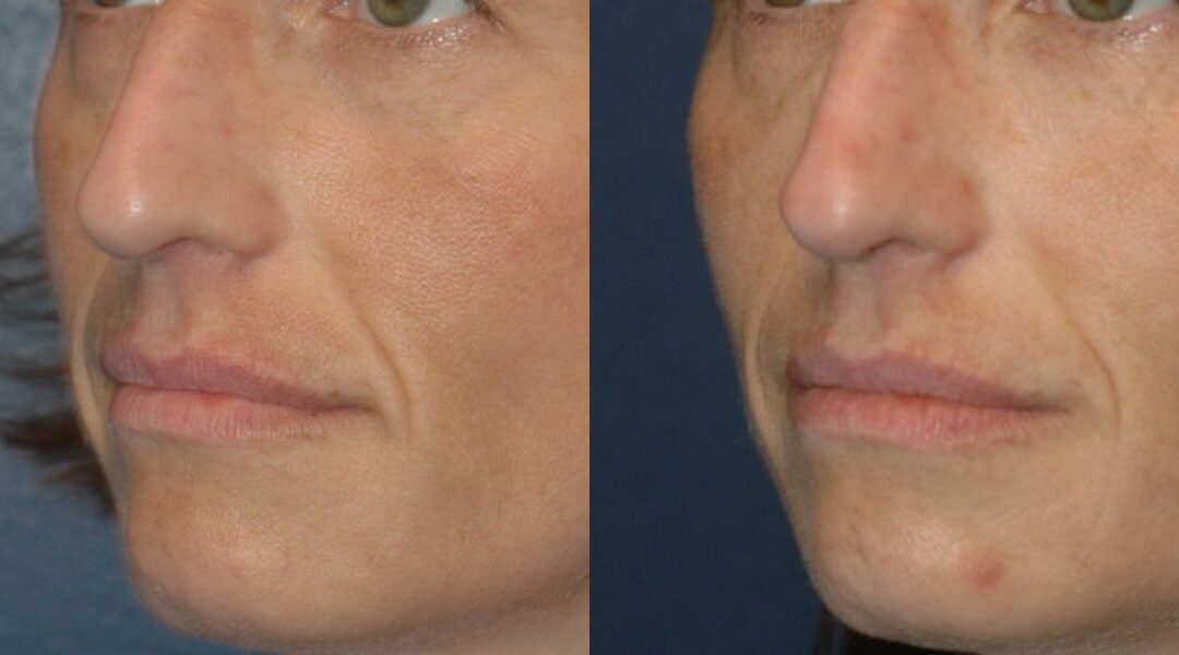 Sculptra