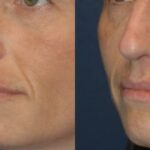 Sculptra - Before and After