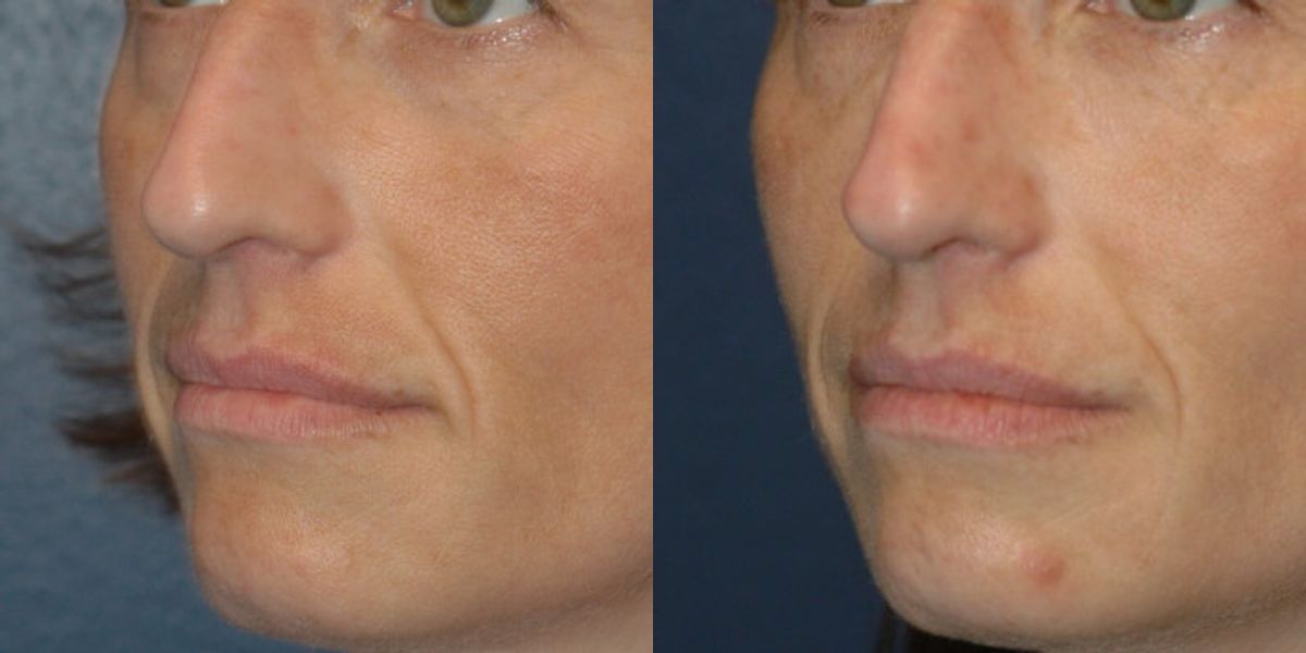 Sculptra - Before and After