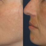Sculptra - Before and After