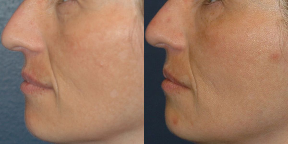 Sculptra - Before and After