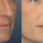 Sculptra - Before and After