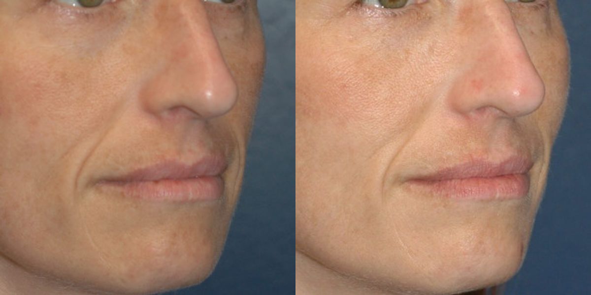 Sculptra - Before and After