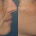 Sculptra - Before and After