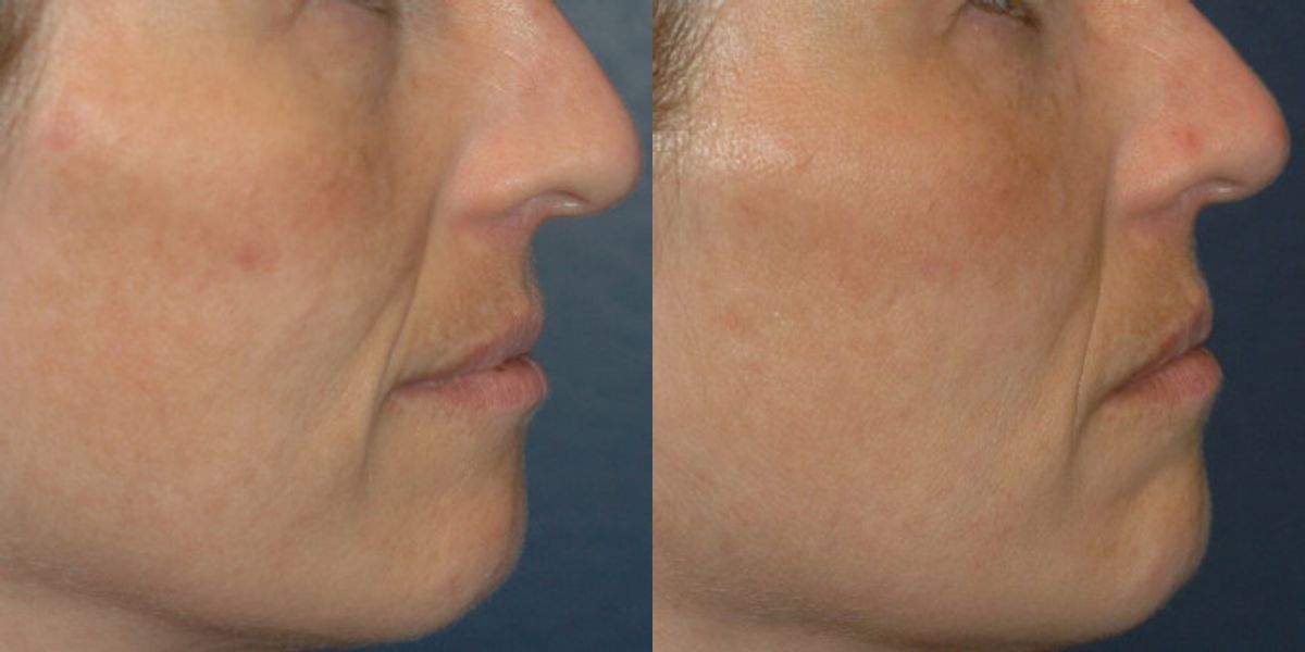 Sculptra - Before and After