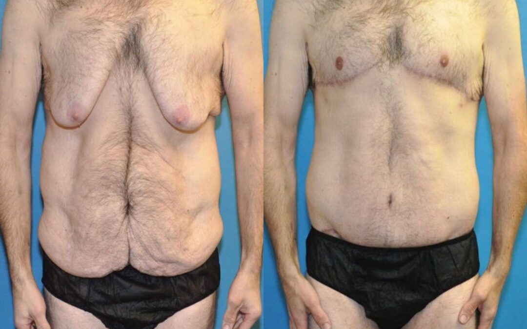 Total Body Lift (Upper and Lower Body Lift) #6