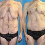 Total Body Lift (Upper and Lower Body Lift) - Before and After