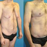 Total Body Lift (Upper and Lower Body Lift) - Before and After
