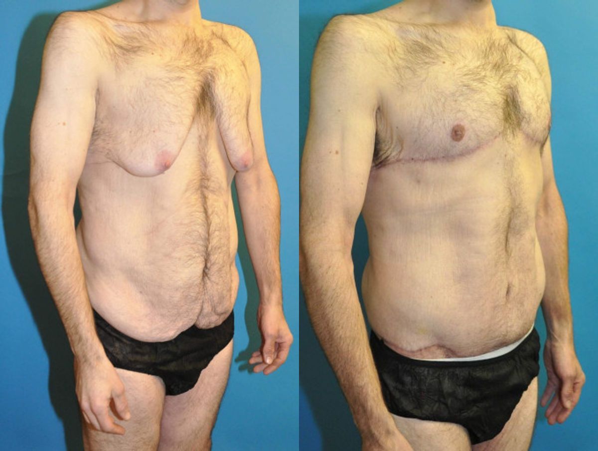 Total Body Lift (Upper and Lower Body Lift) - Before and After
