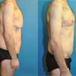 Total Body Lift (Upper and Lower Body Lift) - Before and After